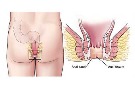 Hemorrhoids Treatment in Nanded